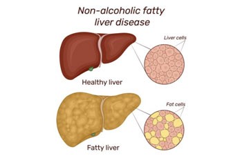 “Liver on the Edge: Fatty Liver Facts and Fiction”